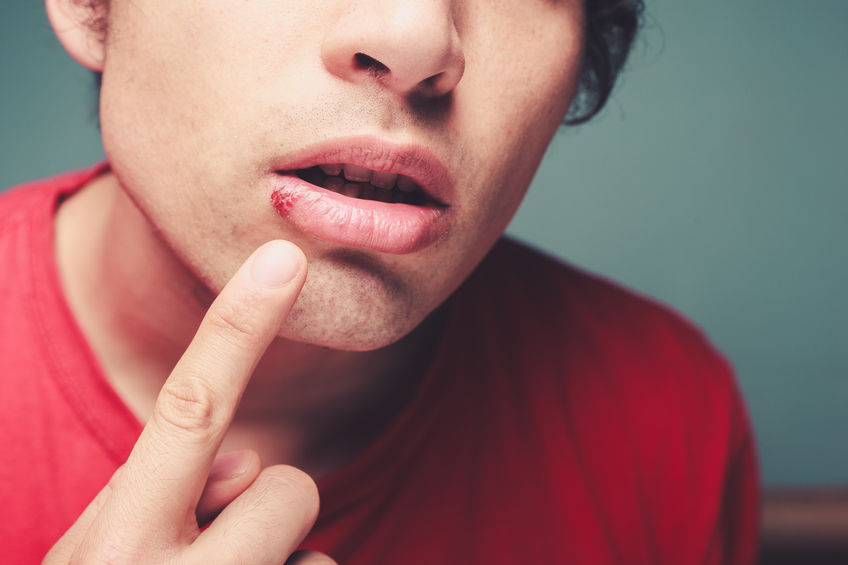 Herpes Symptome: Anzeichen von Lippenherpes