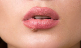 Herpes Therapie