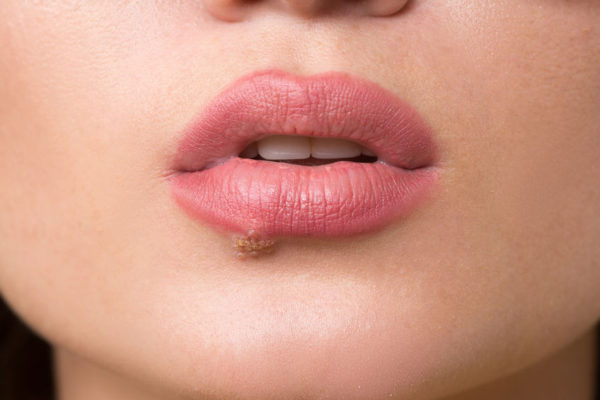 Herpes Therapie