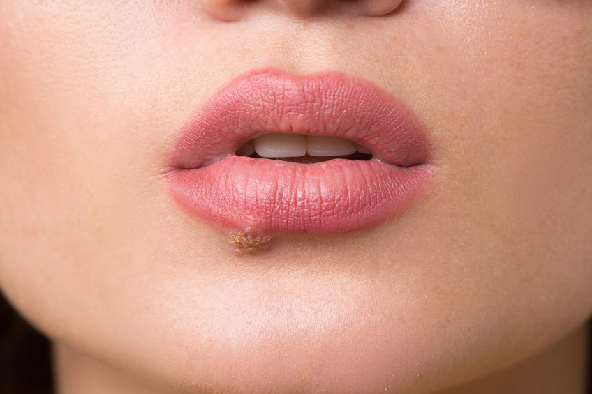 Herpes Therapie: Was hilft gegen Lippenherpes?