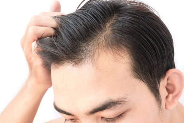 Haartransplantation