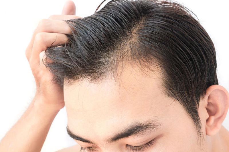 Wann macht eine Haartransplantation Sinn?