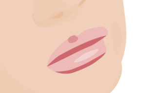 Lippenherpes (Herpes labialis)