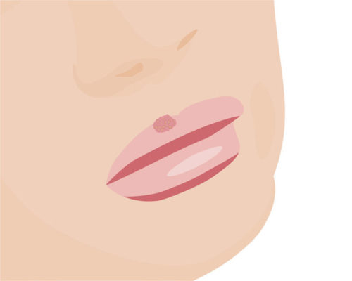 Lippenherpes (Herpes labialis)