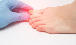 Nagelpilzinfektion kann die ganze Familie betreffen